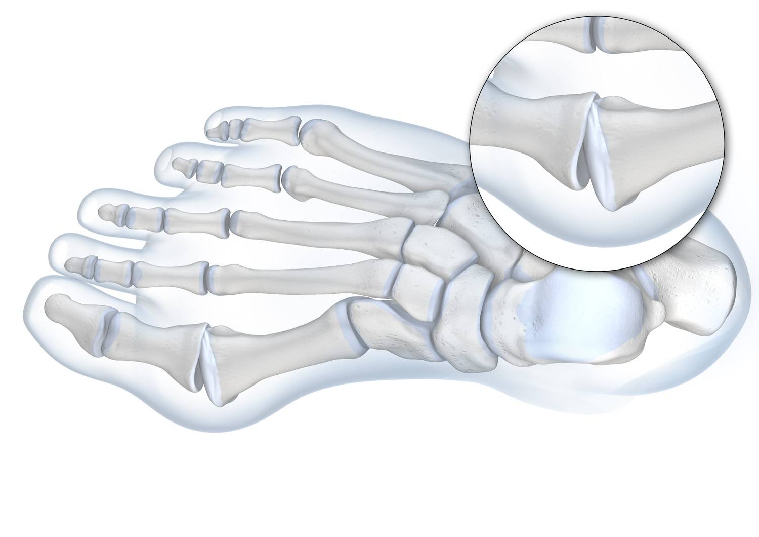 ErgoPad Redux Hallux - medicinsk indlæg til knyst
