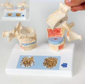 Bauerfeind Anatomisk model - Osteoporose